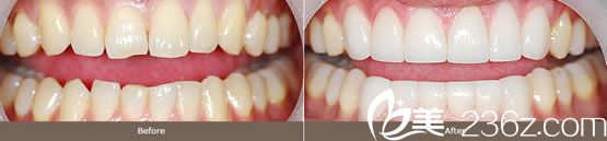 氧化鋯生物陶瓷美容冠效果 氧化鋯生物陶瓷美容冠效果