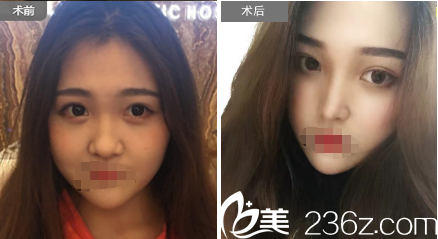 蘇州紫馨邵剛玻尿酸隆鼻案例