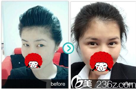 雙眼皮加上瞼下垂前對后壁 雙眼皮加上瞼下垂前對后壁