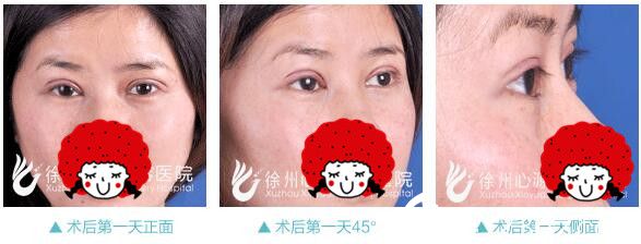徐州心源做雙眼皮術(shù)后天 徐州心源做雙眼皮術(shù)后天