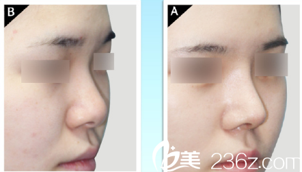 韓國現(xiàn)代美學(xué)整形醫(yī)院案例 韓國現(xiàn)代美學(xué)整形醫(yī)院案例