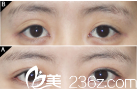 韓國現(xiàn)代美學(xué)整形醫(yī)院案例 韓國現(xiàn)代美學(xué)整形醫(yī)院案例