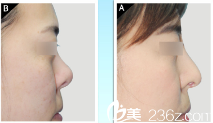 韓國現(xiàn)代美學(xué)整形醫(yī)院案例