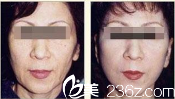 韓國現(xiàn)代美學(xué)整形醫(yī)院案例