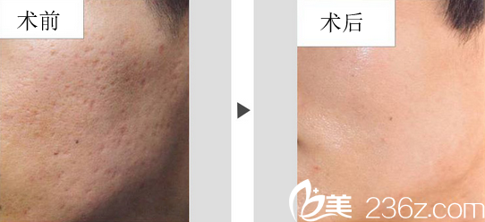安徽韓美羅定安祛疤案例對比照片 安徽韓美羅定安祛疤案例對比照片