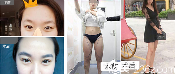 安徽韓美閆品行雙眼皮、吸脂案例