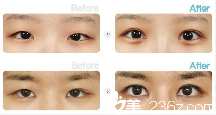 安徽韓美劉冷雙眼皮案例對比照片 安徽韓美劉冷雙眼皮案例對比照片