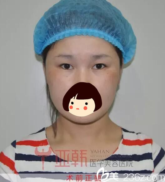 蘭州亞韓雙眼皮術(shù)前正面照 蘭州亞韓雙眼皮術(shù)前正面照