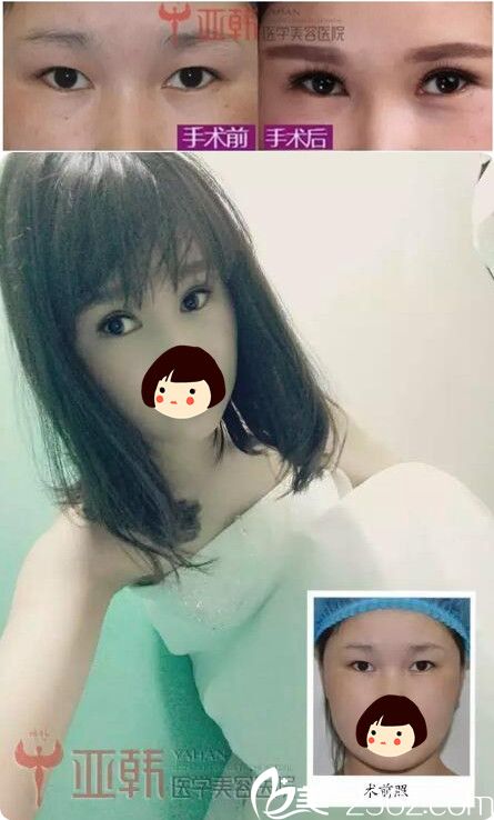 蘭州亞韓做埋線自然雙眼皮整形案例