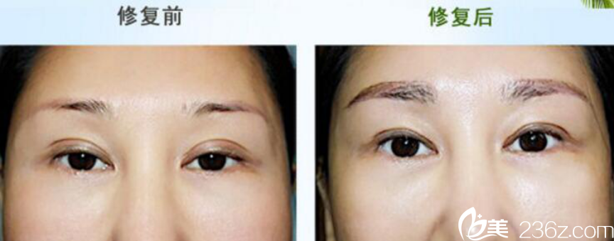 BIO整形外科洪星杓院長雙眼皮過寬修復(fù) BIO整形外科洪星杓院長雙眼皮過寬修復(fù)