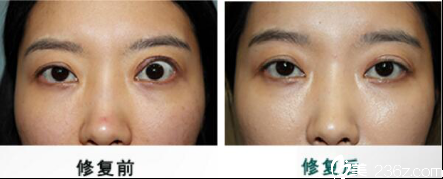 BIO整形外科洪星杓院長做雙眼皮上瞼下垂矯正怎么樣？雙眼皮修復、上瞼下垂矯正修復案例對比