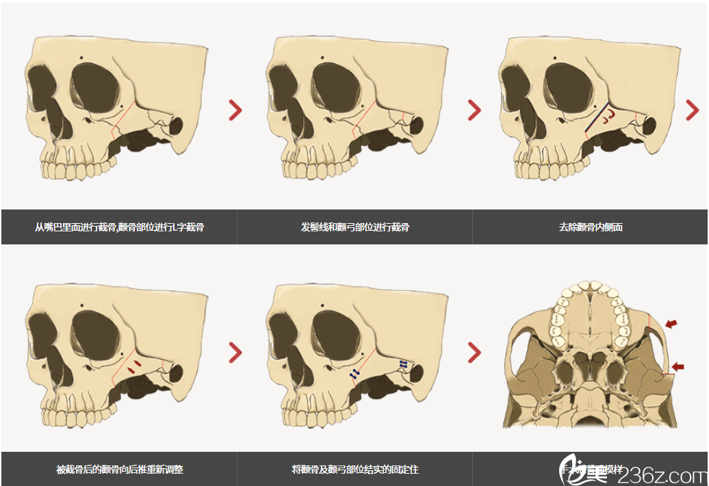 韓國齊娥牙科顴骨手術(shù)示意圖