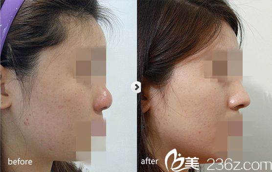 假體隆鼻前后對比圖