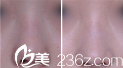 韓國(guó)心美眼整形外科案例 韓國(guó)心美眼整形外科案例