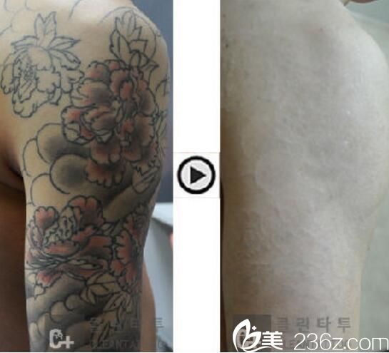 樸在雄 院長洗紋身案例