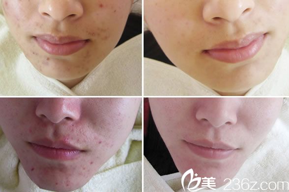 姚平祛痘案例效果 姚平祛痘案例效果