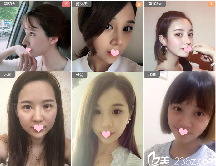 廣州藝美整形醫(yī)院李闖院長隆鼻案例