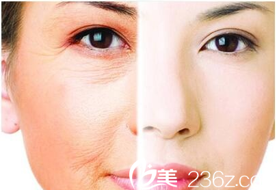 韓國秀美顏(TOP FACE)整容外科埋線提升宣傳圖 韓國秀美顏(TOP FACE)整容外科埋線提升宣傳圖