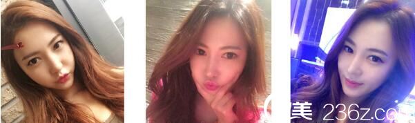 我在韓國Topclass整形外科花26000元眼型矯正+開外眼角，金行準院長真人案例