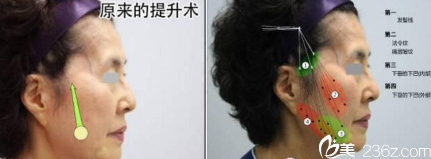 原來提升術(shù)和韓國德社羅伊整形外科樸明旭提升術(shù)區(qū)別 原來提升術(shù)和韓國德社羅伊整形外科樸明旭提升術(shù)區(qū)別