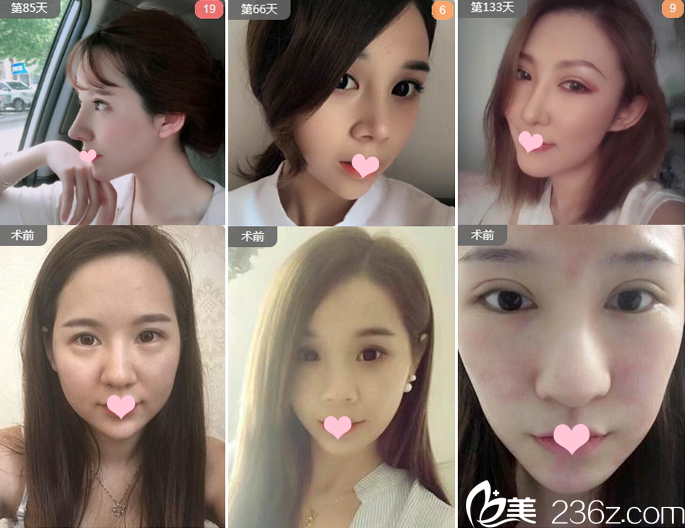 廣州藝美李闖隆鼻及鼻修復(fù)案例 廣州藝美李闖隆鼻及鼻修復(fù)案例