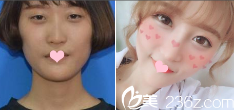 廣州藝美李闖割雙眼皮案例 廣州藝美李闖割雙眼皮案例