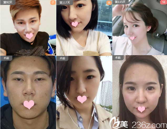 廣州藝美整形醫(yī)院張濤雙眼皮修復案例 廣州藝美整形醫(yī)院張濤雙眼皮修復案例