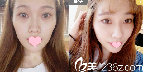 廣州藝美整形醫(yī)院張濤主任脂肪填充案例 廣州藝美整形醫(yī)院張濤主任脂肪填充案例