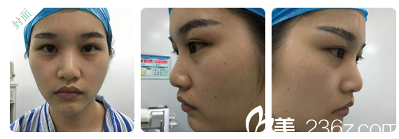 隆鼻失敗術(shù)前照片 隆鼻失敗術(shù)前照片