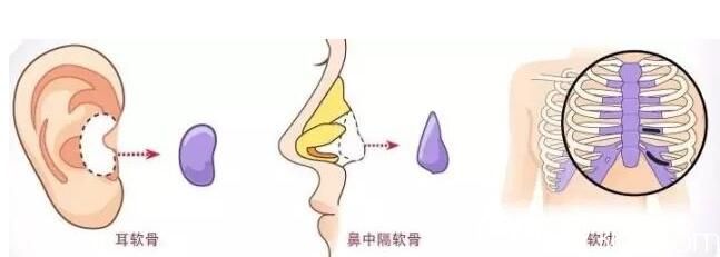 韓國(guó)VIP整形外科自體組織鼻整形 韓國(guó)VIP整形外科自體組織鼻整形