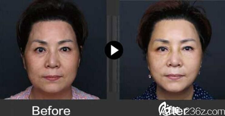 三重埋線提升 樸明旭院長(zhǎng)