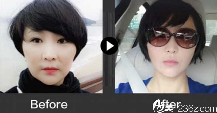 樸明旭面部提升效果怎么樣