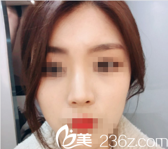 在韓國心美眼整形外科花了5800元做的玻尿酸隆鼻，醫(yī)生真人案例