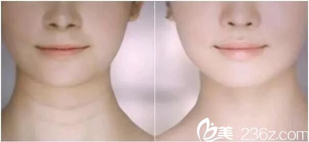 連云港大明親身體驗嗨體去頸紋，完美“天鵝頸”案例效果