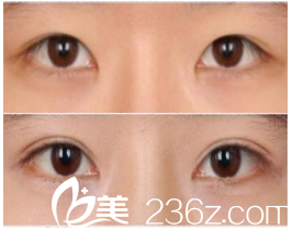 韓國秀美顏（TOP FACE）宋宣昊雙眼皮過寬修復怎么樣？雙眼皮過寬+過窄修復真人案例