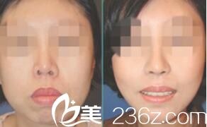 韓國VIP整形外科朝天鼻矯正 韓國VIP整形外科朝天鼻矯正