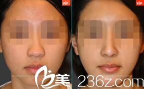 韓國VIP整形外科朝天鼻矯正 韓國VIP整形外科朝天鼻矯正