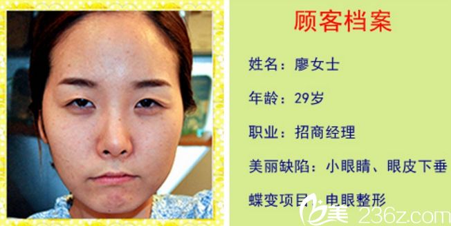 韓國新帝瑞娜整形醫(yī)院雙眼皮真人案例