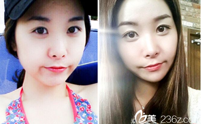 鄭鐘必院長做雙眼皮手術(shù)好嗎