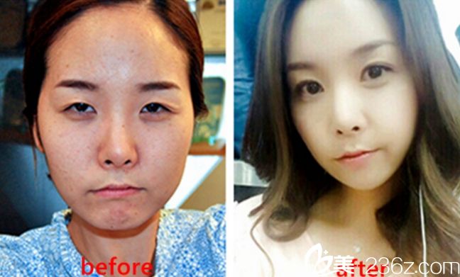 （灰姑娘整形）鄭鐘必院長做雙眼皮大概多少錢？真人案例對比