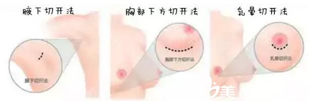 隆胸切口位置