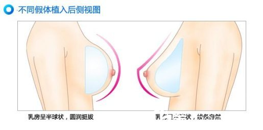 隆胸假體材料的形狀