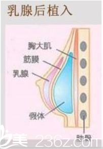 乳腺后植入假體隆胸