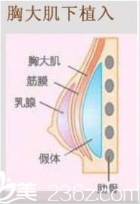 胸大肌下植入假體隆胸