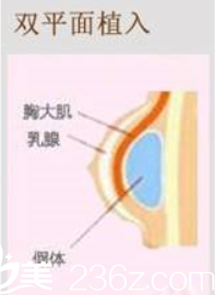 雙平面植入假體隆胸