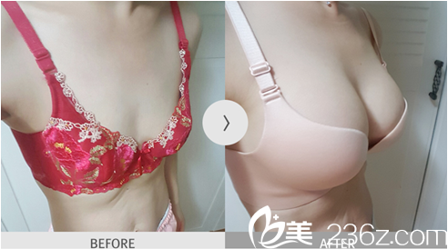 韓國麥恩醫(yī)院李圣郁假體隆胸真人案例