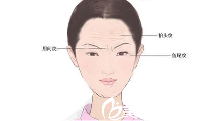 平時面部表情過多，時間久了慢慢形成皺紋