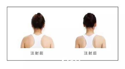 瘦肩的原理跟瘦腿的原理一樣