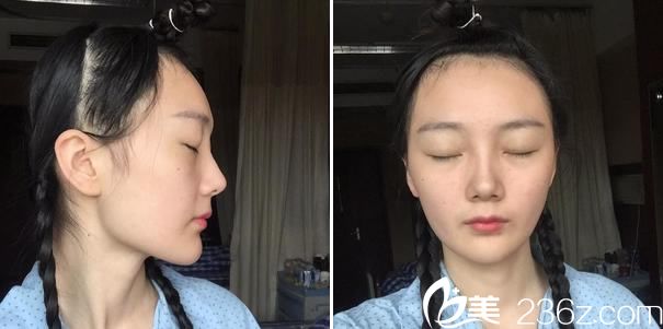 在<!--<i data=20240703-sp></i>-->做下頜角前 在<!--<i data=20240703-sp></i>-->做下頜角前