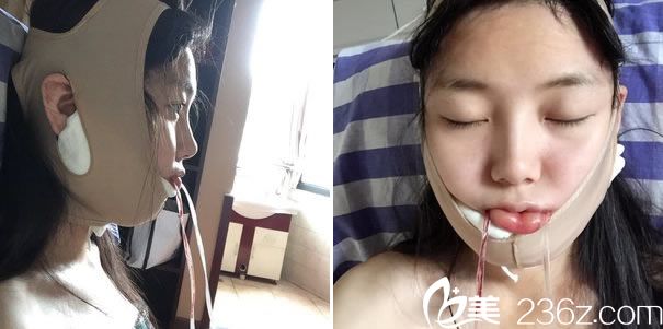 下頜角整形手術(shù)后戴頭套照片 下頜角整形手術(shù)后戴頭套照片